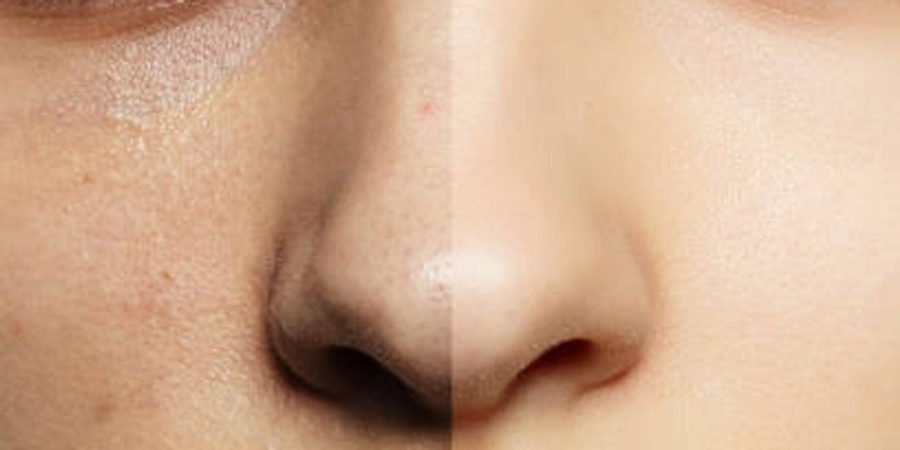 Chemical Peels: The Secret to Brighter, Younger-Looking Skin